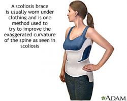 17 best Scoliosis Information images on Pinterest | Scoliosis ...
