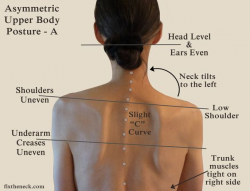 OMG! I LoVE this site! Overcoming Chronic Neck Pain: Postural Causes ...