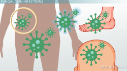 Fungal & Yeast Skin Infections Vocabulary - Video & Lesson ...