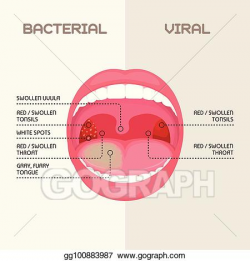 Vector Stock - Throat bacterial and viral infection, tonsils ...