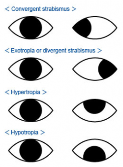 Strabismus (Lazy Eye) and Heterophoria