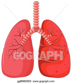 Vector Art - Lung diagram with pneumonia. Clipart Drawing gg86662925 ...
