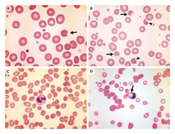 Diagnosis from the Blood Smear | NEJM