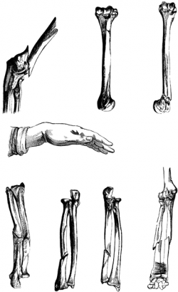 Types of Broken Bones | ClipArt ETC