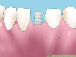 Easy Ways to Reverse Dental Bone Loss - wikiHow