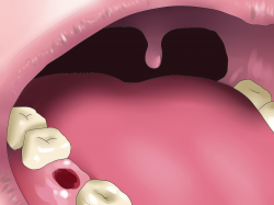 Easy Ways to Reverse Dental Bone Loss - wikiHow