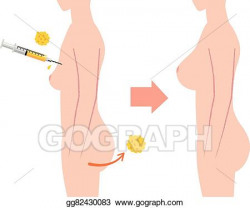 Vector Stock - Breast fatgrant surgery with sideview of body. Stock ...