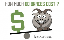 How Much Do Braces Cost? Our In-Depth Investigation