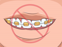 How to Choose the Color of Your Braces: 14 Steps (with Pictures)
