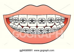 Clip Art Vector - Teeth with braces. Stock EPS gg94589991 ...