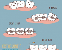Teeth Braces | Pico Rivera's Best Family Dentists | Direct Dental ...