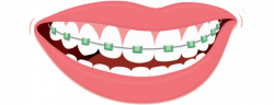 Braces Archives - South Bay Dental & Orthodontics