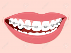 28+ Collection of Smile With Braces Drawing | High quality, free ...