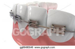 Stock Illustration - Human teeth extreme closeup with metal braces ...