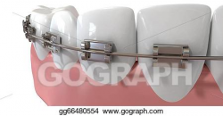 Stock Illustration - Human teeth extreme closeup with metal braces ...
