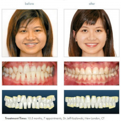 44 best Orthodontic Braces images on Pinterest | Braces for teeth ...