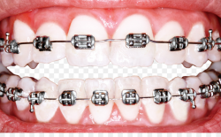 Dental braces Dentistry Orthodontics Tooth whitening - Perfect Teeth ...