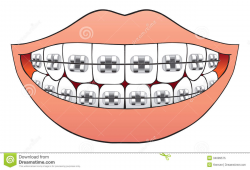 28+ Collection of Smile With Braces Drawing | High quality, free ...