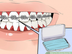 How to Fix a Broken Braces Wire: 6 Steps (with Pictures) - wikiHow