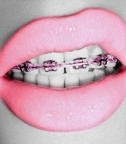20 best Orthodontics images on Pinterest | Dental health ...