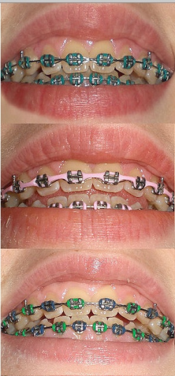28 best Customized braces images on Pinterest | Braces, Orthodontics ...