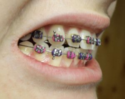Braces and pain | braces for Liv | Pinterest | Braces pain and Teeth