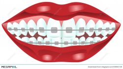 Teeth With Braces Illustration 33550130 - Megapixl