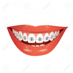 Tooth With Braces Clipart 69695 | MOVIEWEB