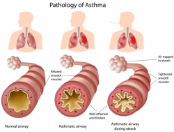 Asthma, Allergic, Shortness of breath, Chest tightness - Young ...