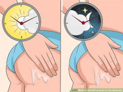 3 Ways to Get Rid of Acne on the Buttocks - wikiHow
