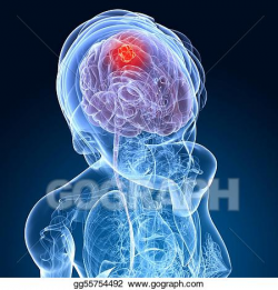 Stock Illustration - Female brain cancer . Clipart gg55754492 - GoGraph