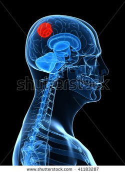 Brain Cancer Clipart