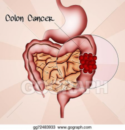 Stock Illustration - Colon cancer. Clipart Drawing gg72483933 - GoGraph