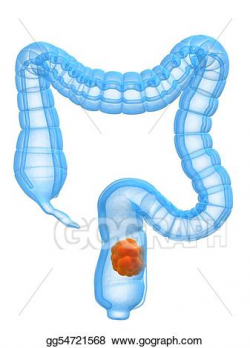 Stock Illustration - Colon cancer. Clipart Drawing gg54721568 - GoGraph