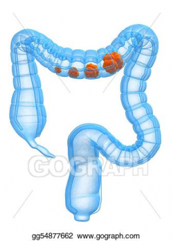 Stock Illustration - Colon cancer stages. Clipart Drawing gg54877662 ...