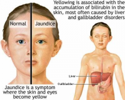 45 best Jaundice images on Pinterest | Clean your liver, Daffodils ...