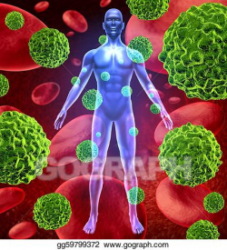 Stock Illustrations - Human body with cancer cells spreading and ...