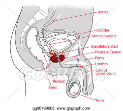 Stock Illustration - Prostate cancer. Clipart Illustrations ...