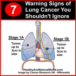 16 best Lung Cancer Awareness images on Pinterest | Lunges, Lungs ...