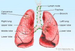 Lung Cancer Picture Image on MedicineNet.com