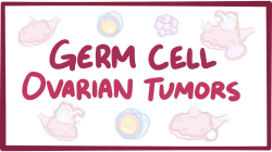 Germ cell ovarian tumors - causes, symptoms, diagnosis, treatment ...