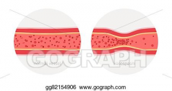 EPS Illustration - Healthy and sick human vessels. Vector Clipart ...