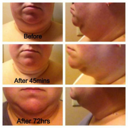 9 best Chin/Neck Before & After Pictures images on Pinterest | Clip ...