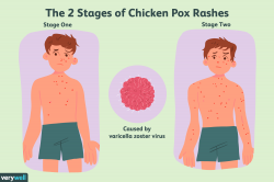 Chickenpox: Symptoms, Causes, Diagnosis, and Treatment