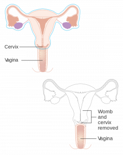 Hysterectomy - Wikipedia