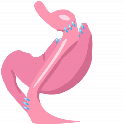 Gastric bypass surgery - Wikipedia
