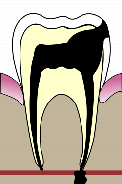 File:Cavities evolution 5.svg - Wikimedia Commons