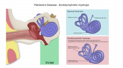 Meniere's Disease/Endolymphatic Hydrops | Ear Institute of Texas ...