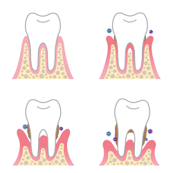 How periodontal (gum) disease causes tooth loss - The Gap Dentist