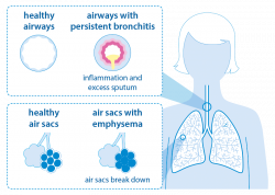 What is COPD? (chronic obstructive pulmonary disease) | British Lung ...